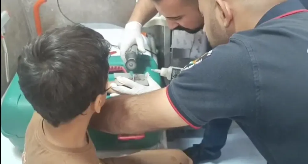 ÇOCUĞUN PARMAĞINA SIKIŞTIRDIĞI CIVATA PULU KESİLEREK ÇIKARTILDI
