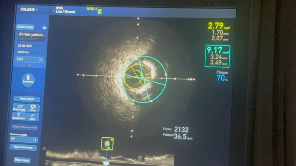 ŞANLIURFA’DA KARDİYOLOJİ ALANINDA BİR İLK: IVUS YÖNTEMİ İLE STENT UYGULAMASI